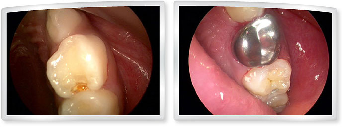 7 years old - with a small cavity