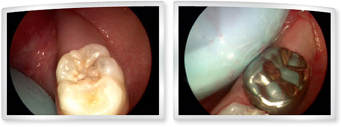 5 years old - large cavity