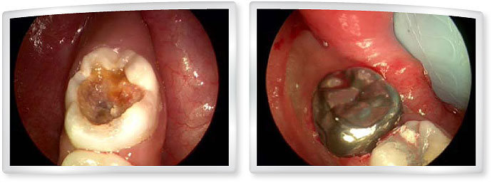 6 years old - large cavity