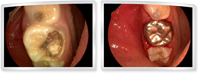 8 years old - very large cavity